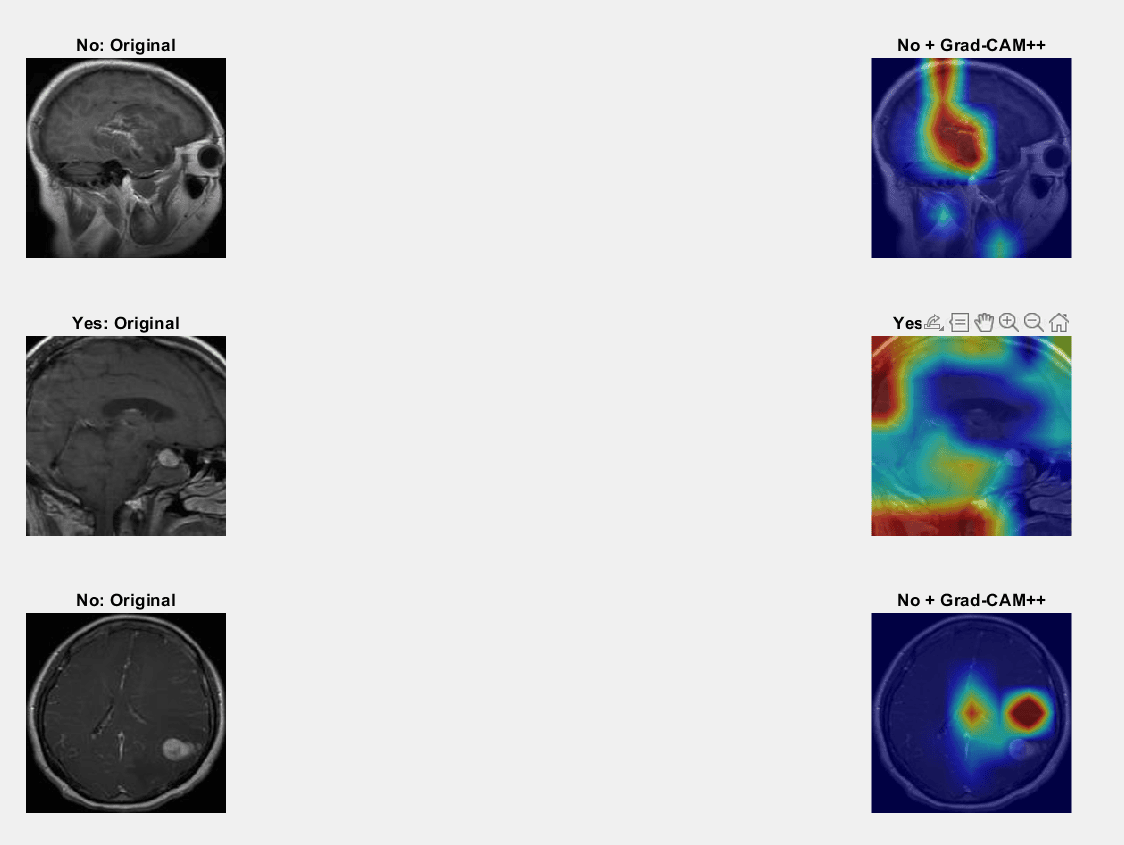 Brain Tumor Detection Using Computer Vision